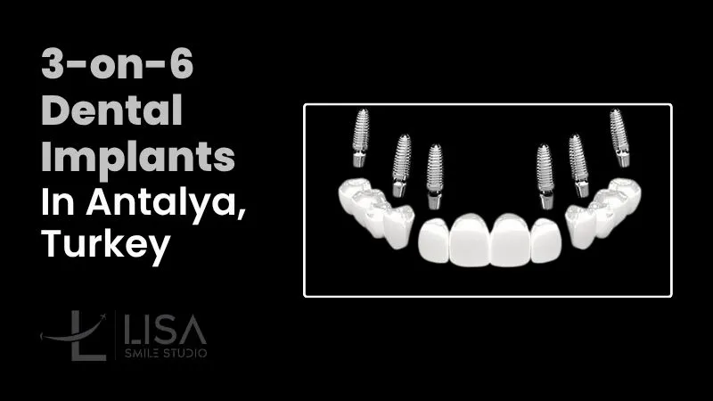 3-on-6 dental implants in Antalya