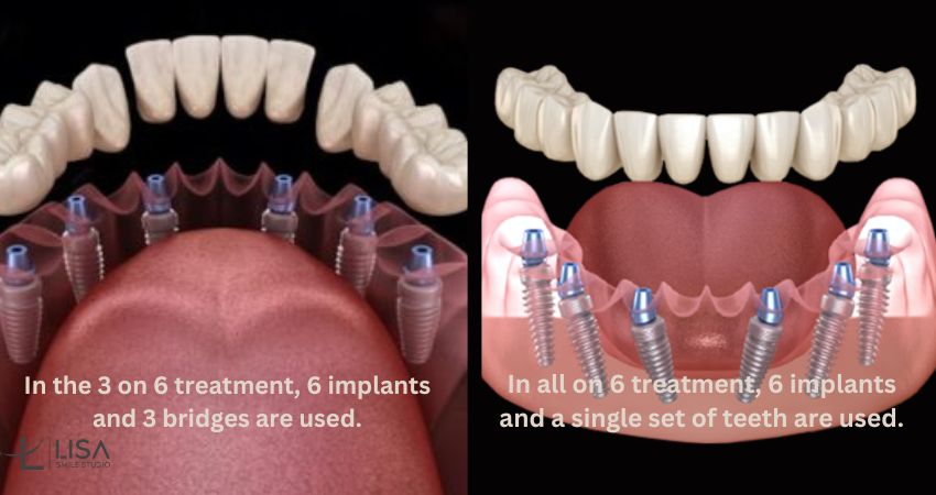 3-on-6 dental implants Antalya