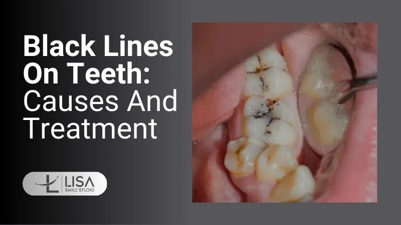 Black Lines On Teeth
