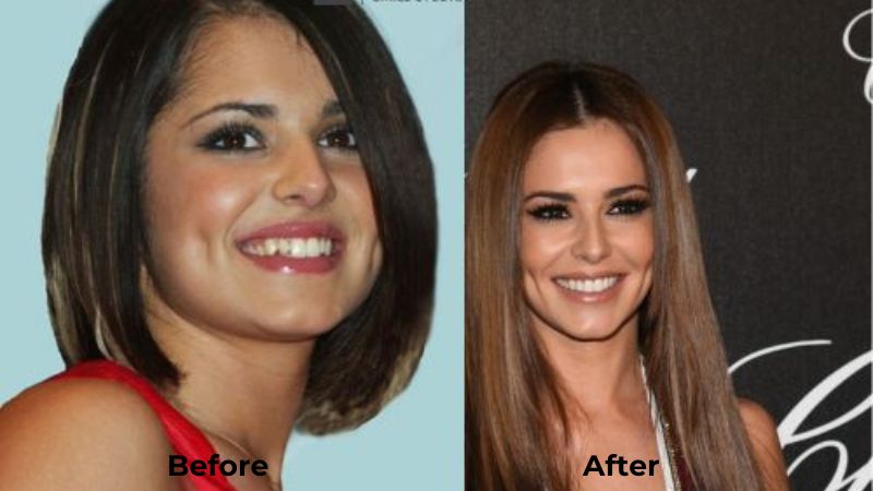 Cheryl Cole Veneers Turkey