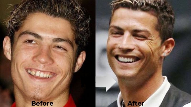 Cristiano Ronaldo Veneers Turkey