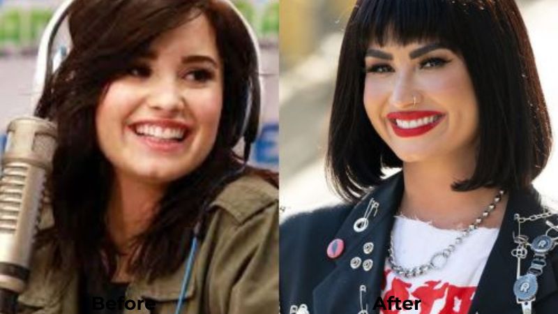 Demi Lovato Veneers Turkey