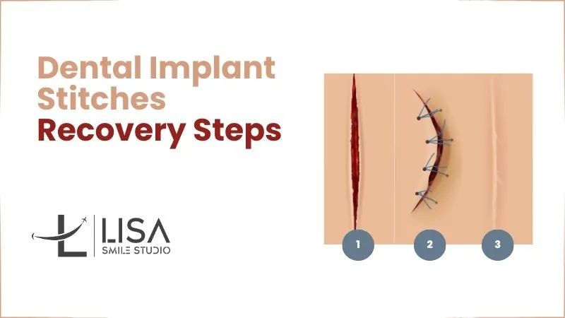 Stitches after dental implant Stitches After Dental Implant in Turkey