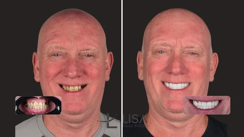 Can dental implants be removed and replaced with dentures