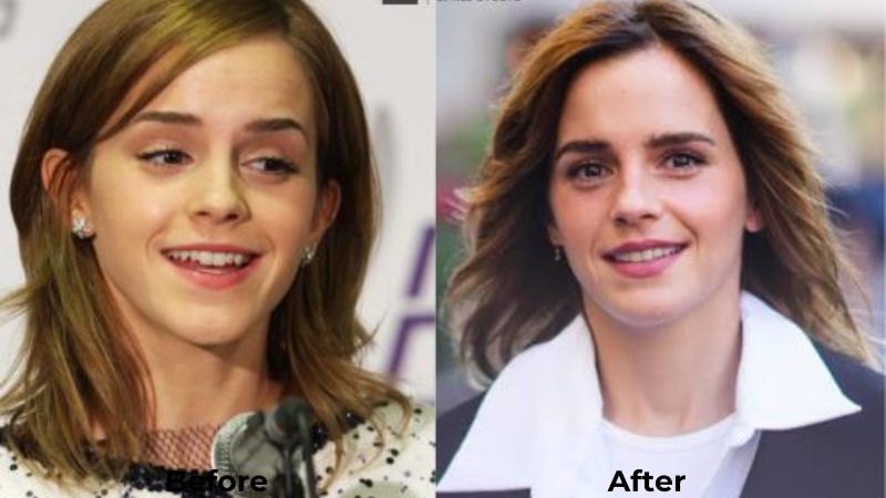 Emma Watson Veneers Turkey