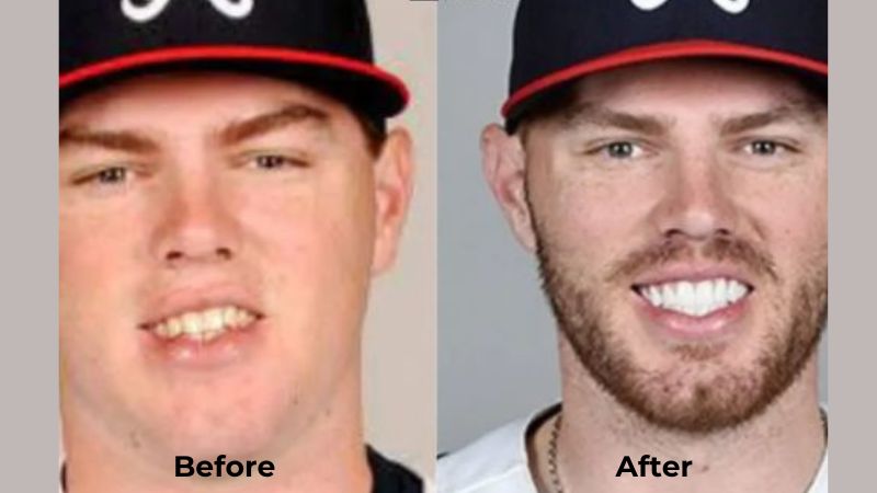 Freddie Freeman Veneers Turkey