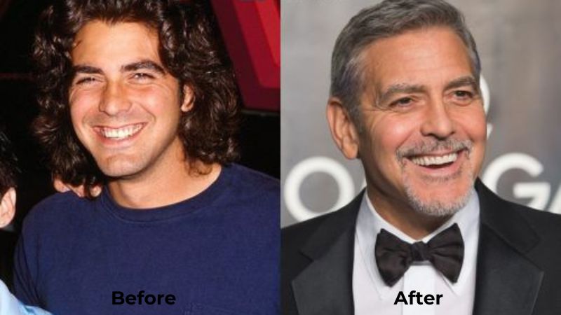 George Clooney Veneers Turkey