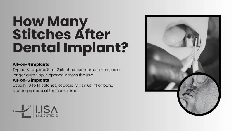 Stitches after dental implants Stitches after dental implants