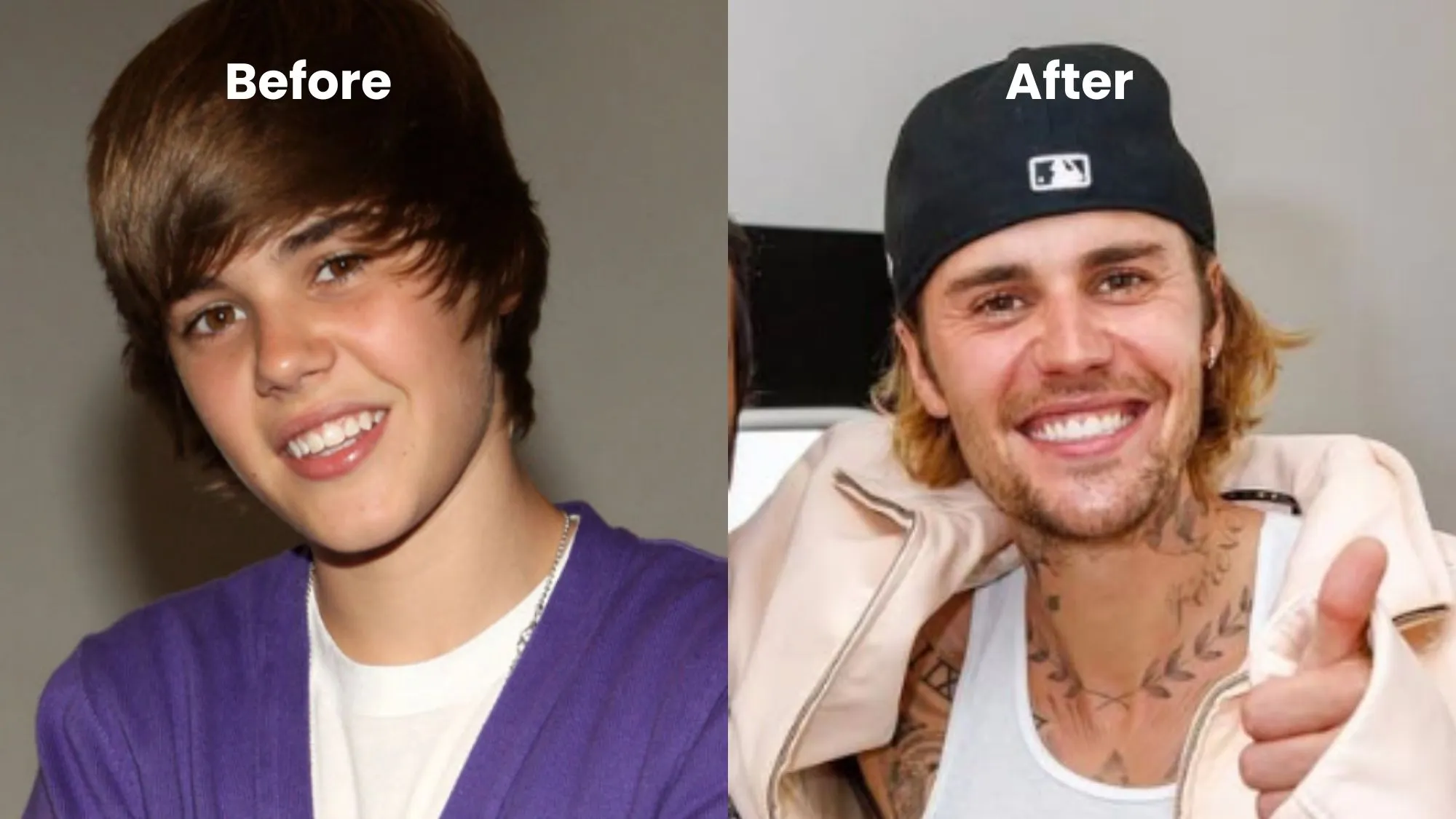 Justin Bieber Veneers