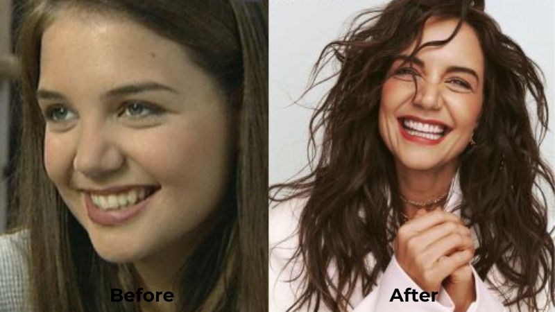 Katie Holmes Veneers Turkey