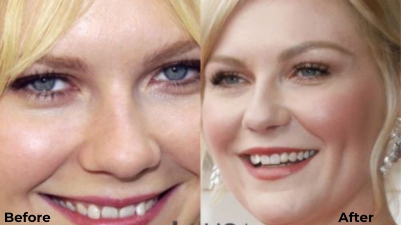 Kirsten Dunst Veneers Turkey