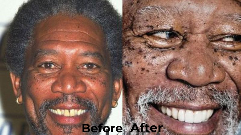 Morgan Freeman Veneers Turkey