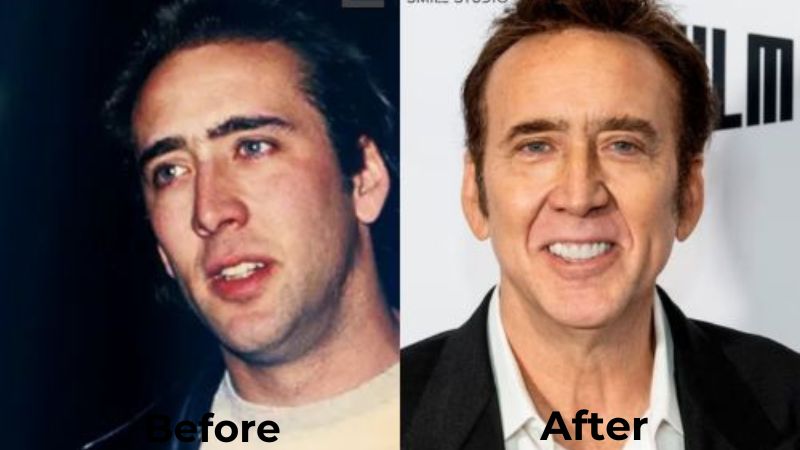 Nicolas Cage Veneers Turkey