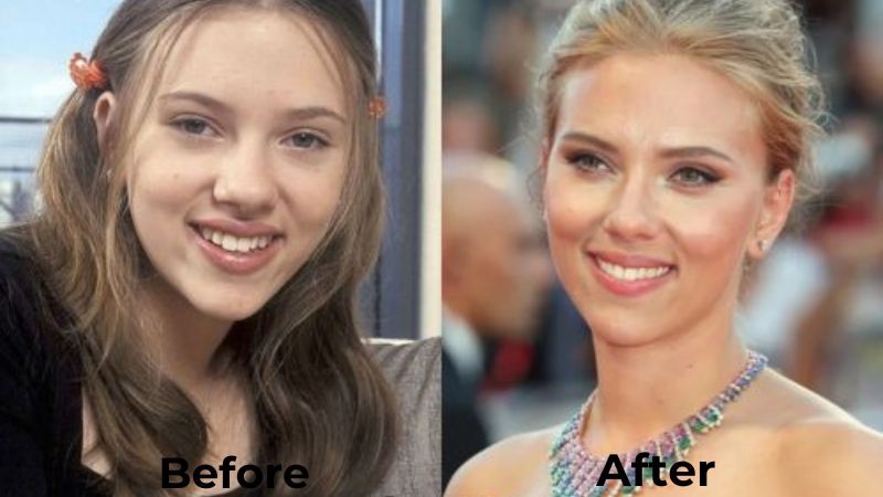 Scarlett Johansson Veneers Turkey