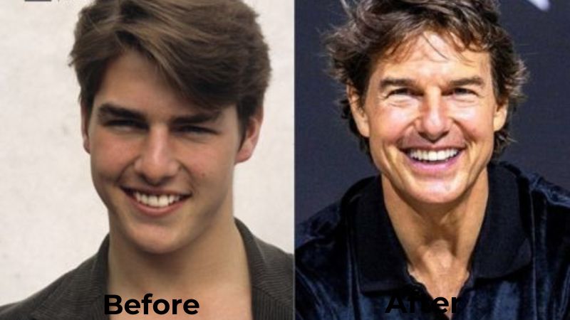 Tom Cruise Veneers Turkey