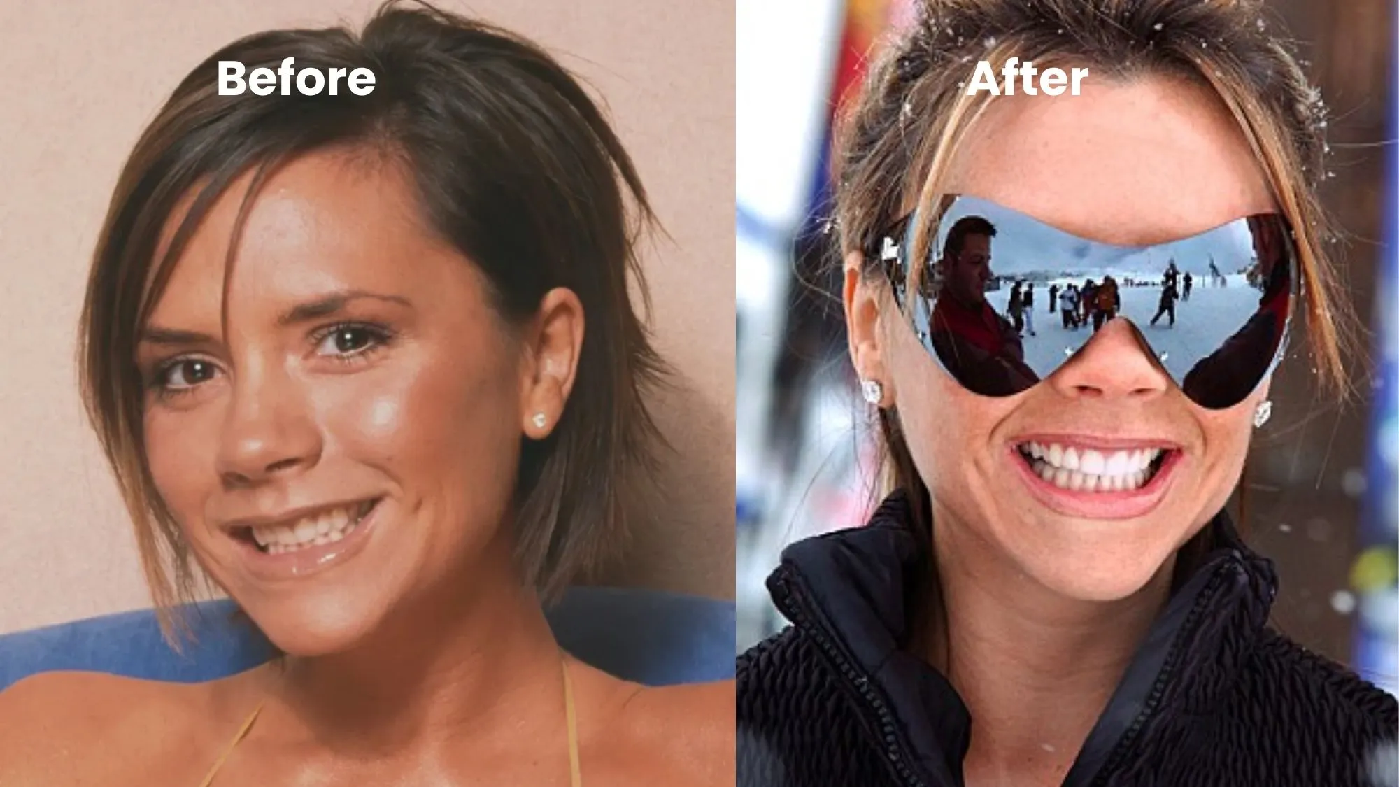 Victoria Beckham Veneers