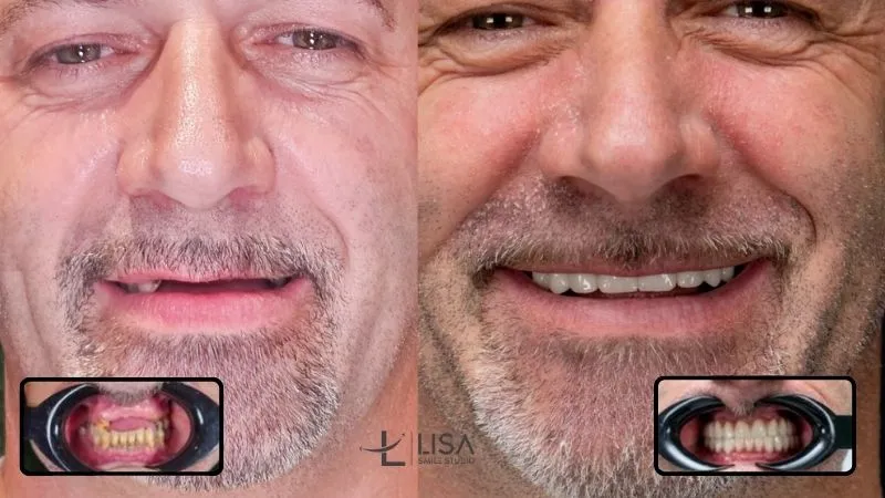 What is the whitest shade of teeth What is the whitest shade of teeth