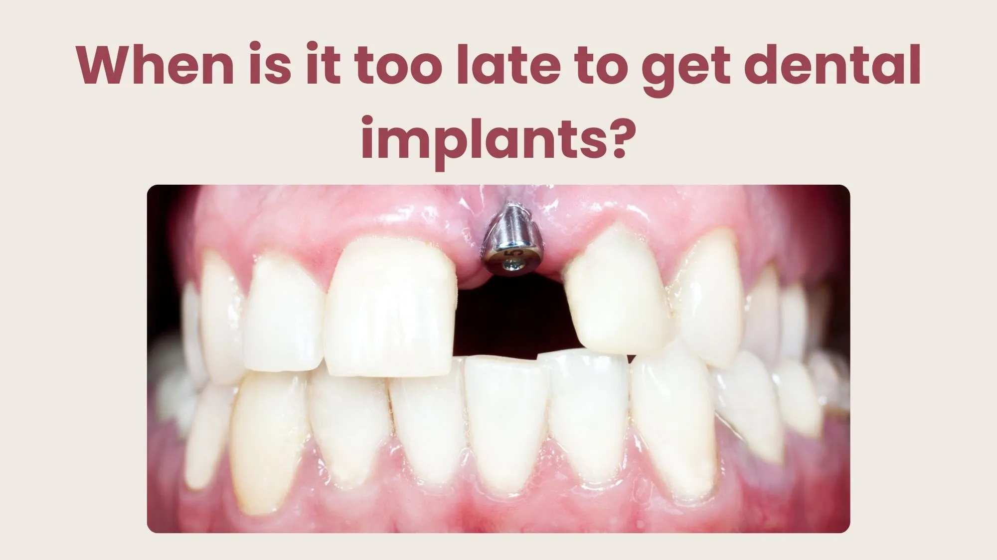 When is it too late to get dental implants?