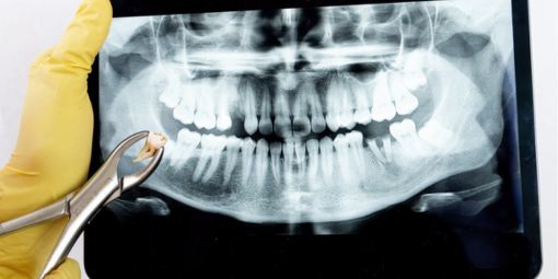 Wisdom Teeth Removal Antalya