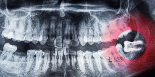 Wisdom Teeth Removal in Turkey