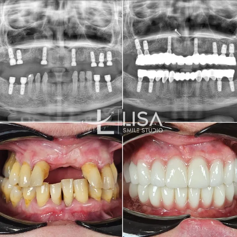 Zirconia Veneer in Turkey