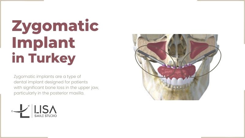 Zygomatic implants in Antalya