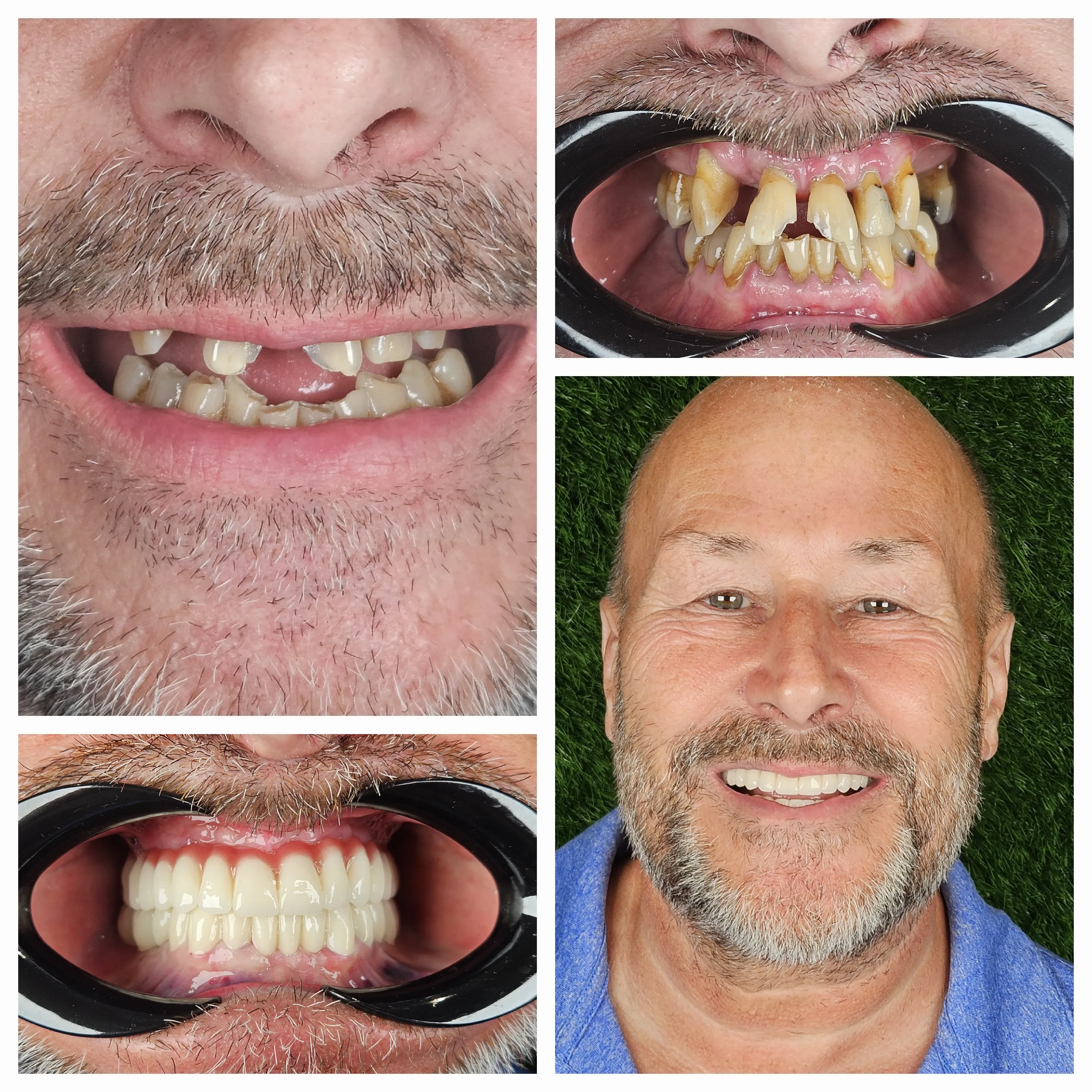 All On Four Dental Implants Turkey