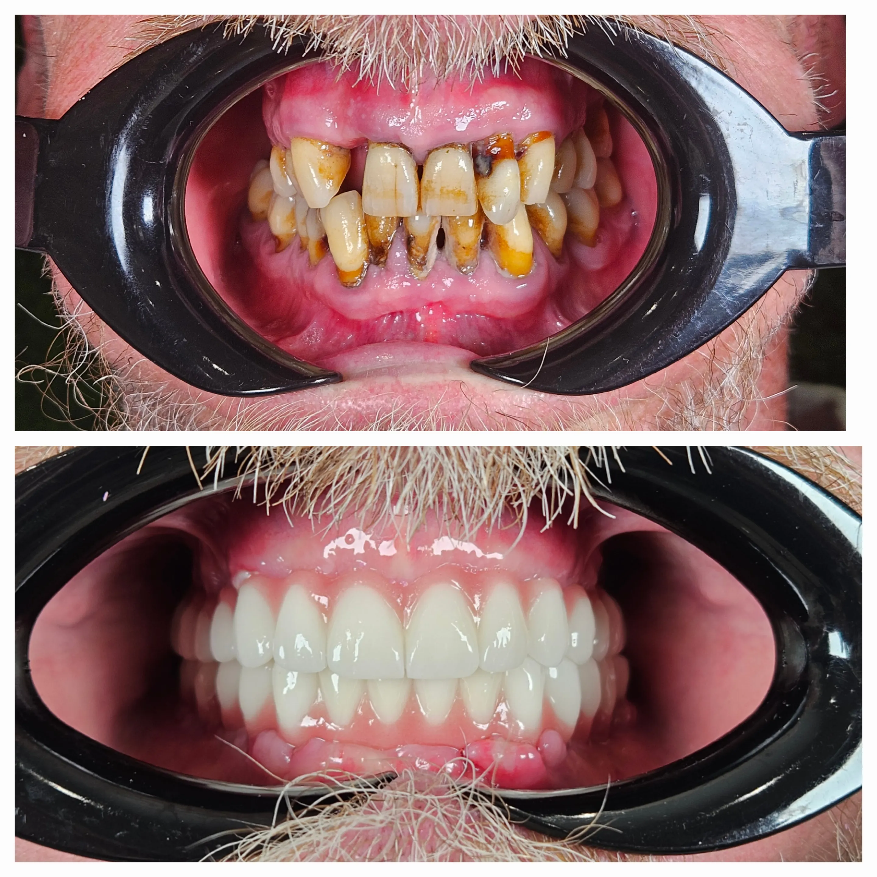 All On 4 Dental Implants Turkey