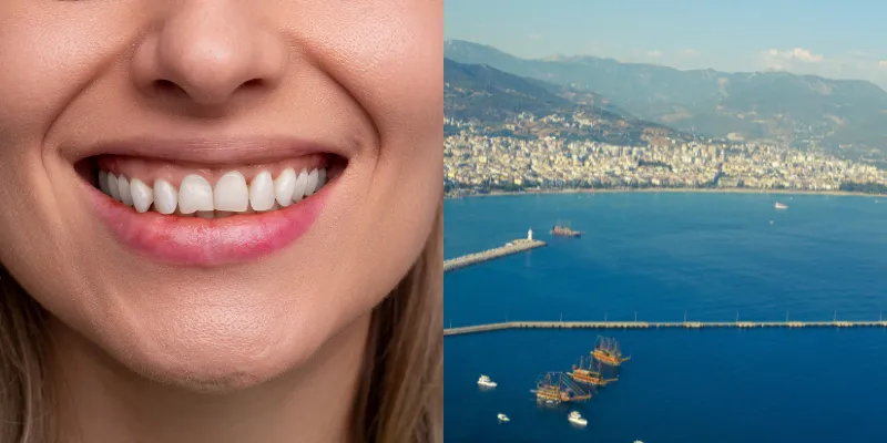 Hollywood Smile in Turkey