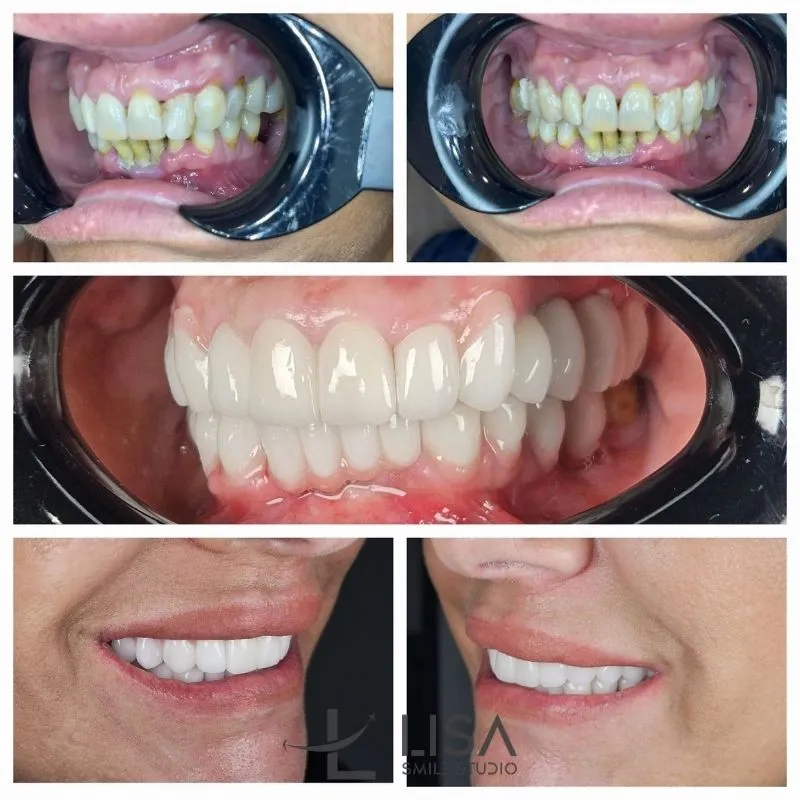 Zirconium crowns before and after photos