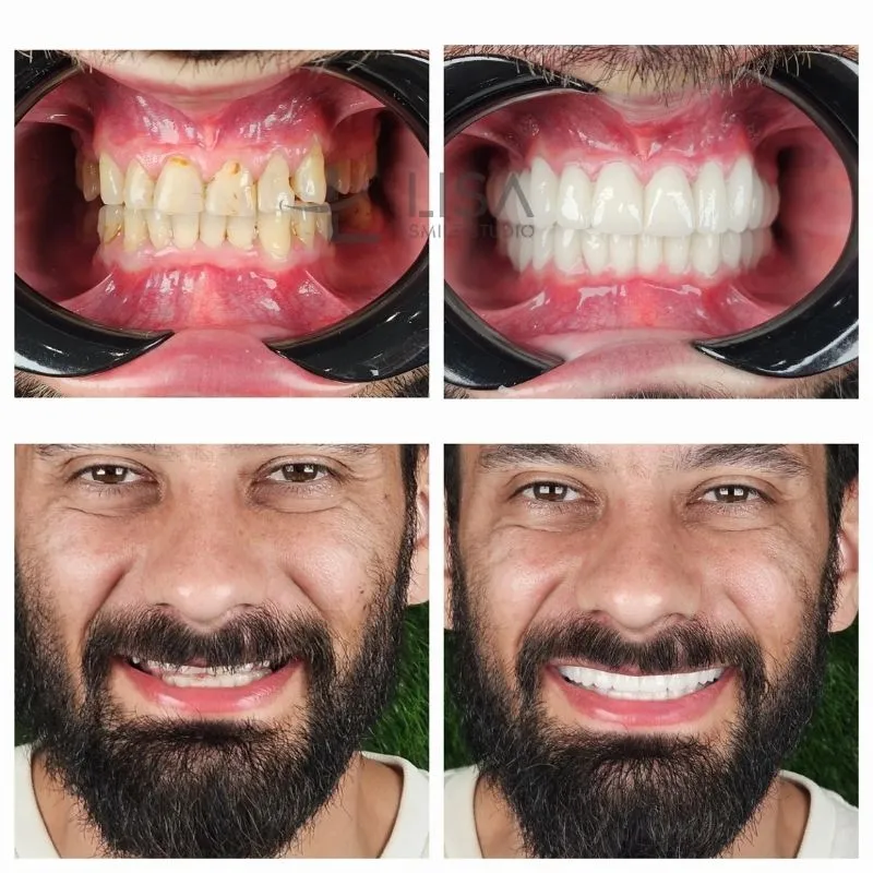 Veneers Turkey