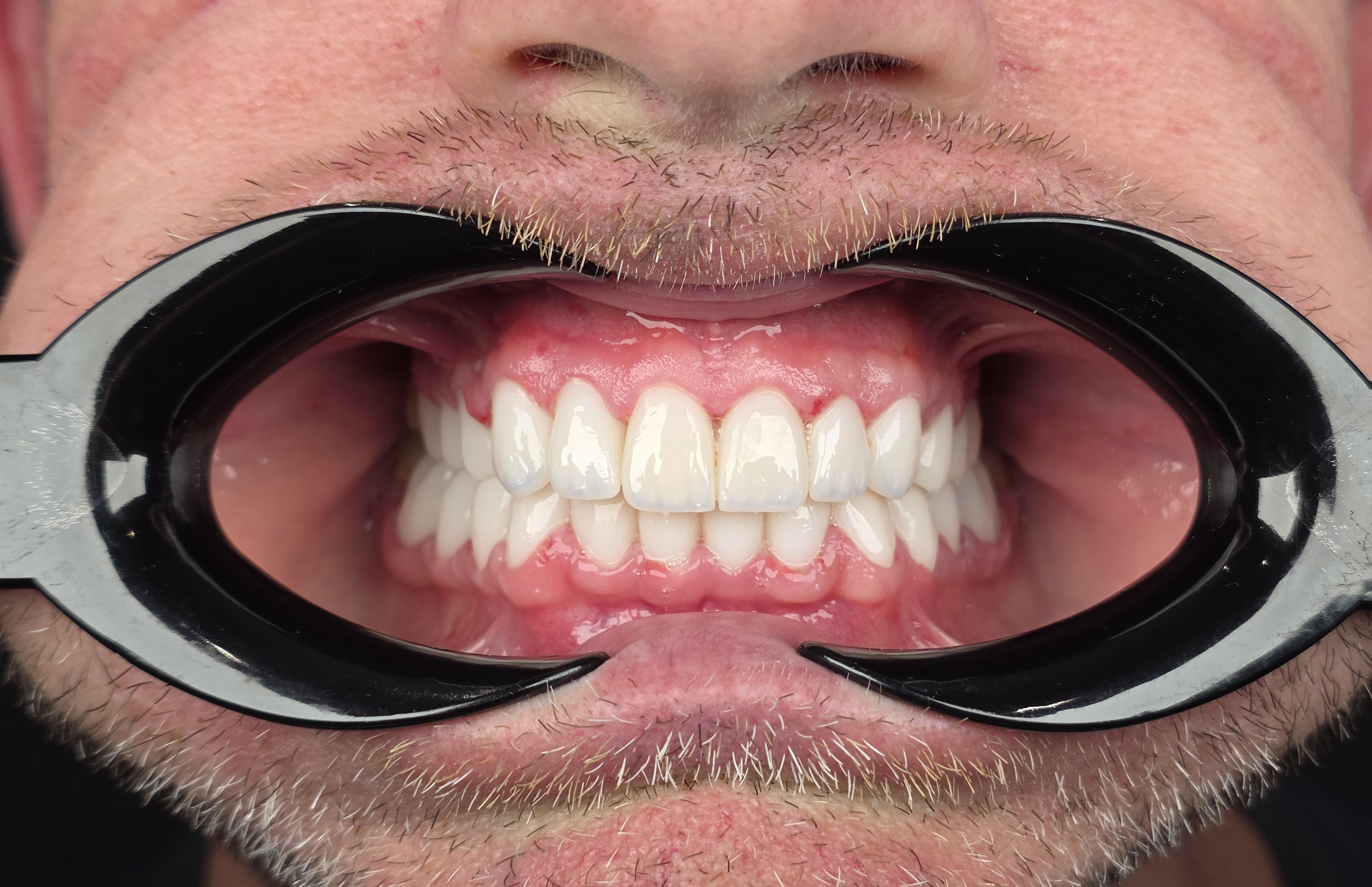 After dental treatment case 1