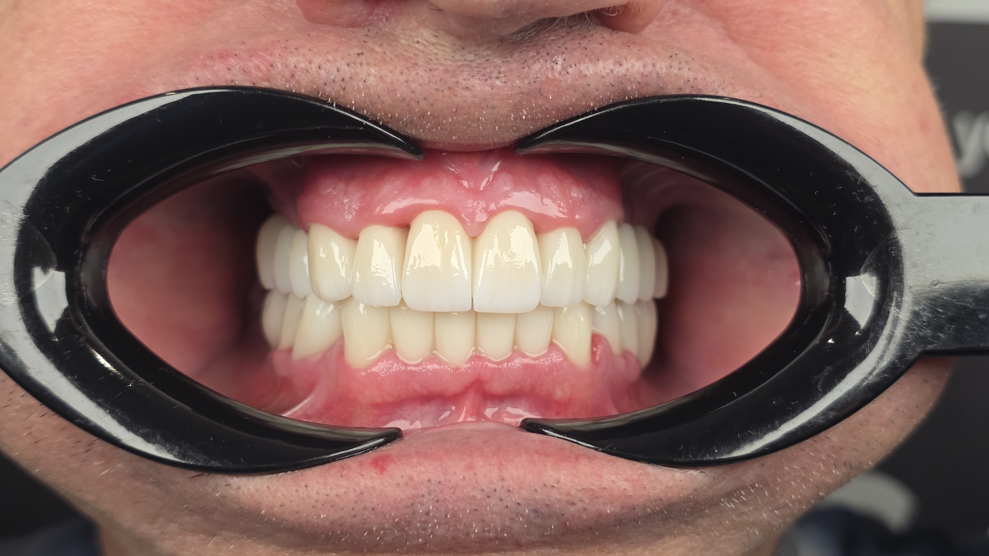 After dental treatment case 2