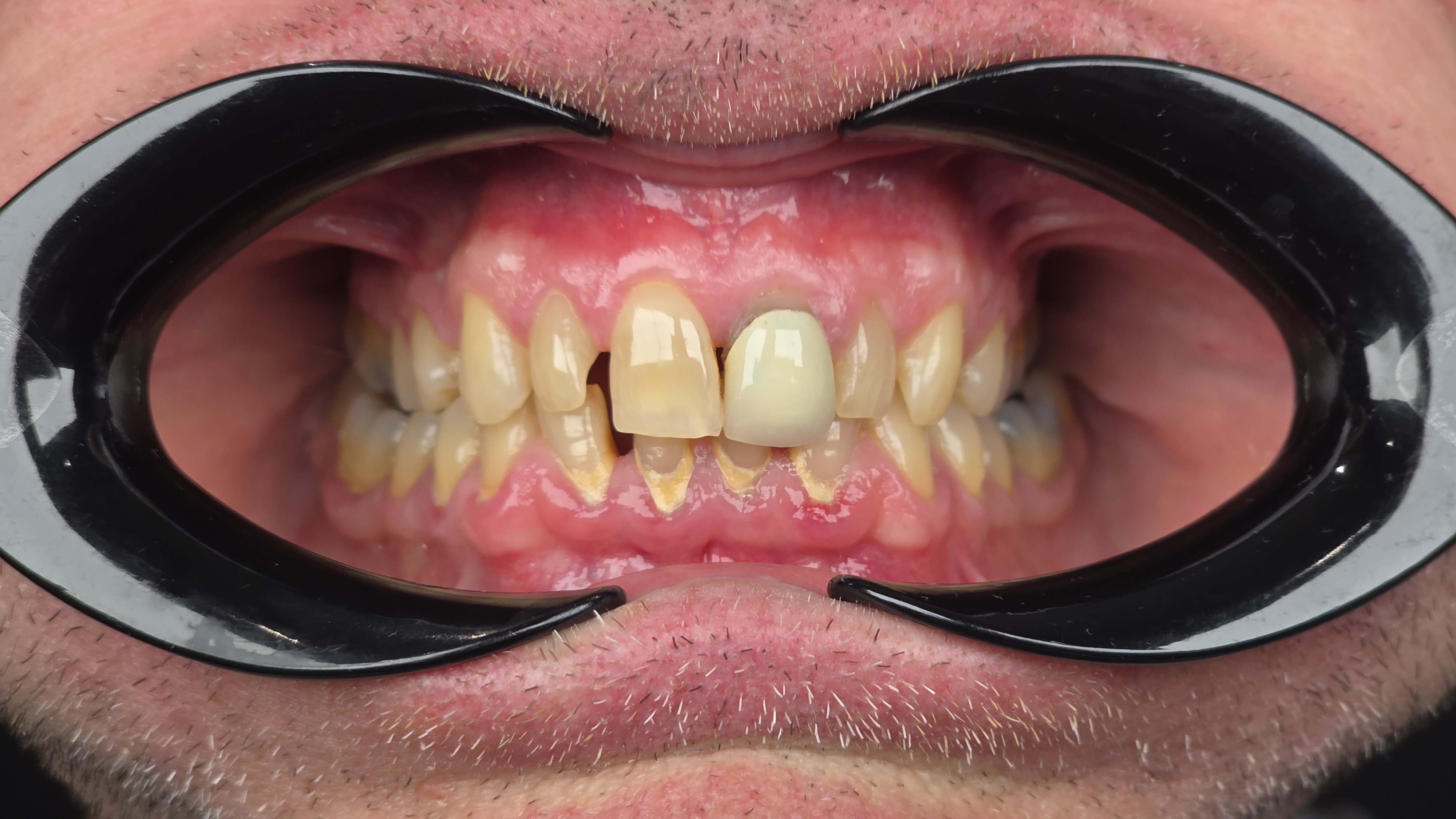 Before dental treatment case 1