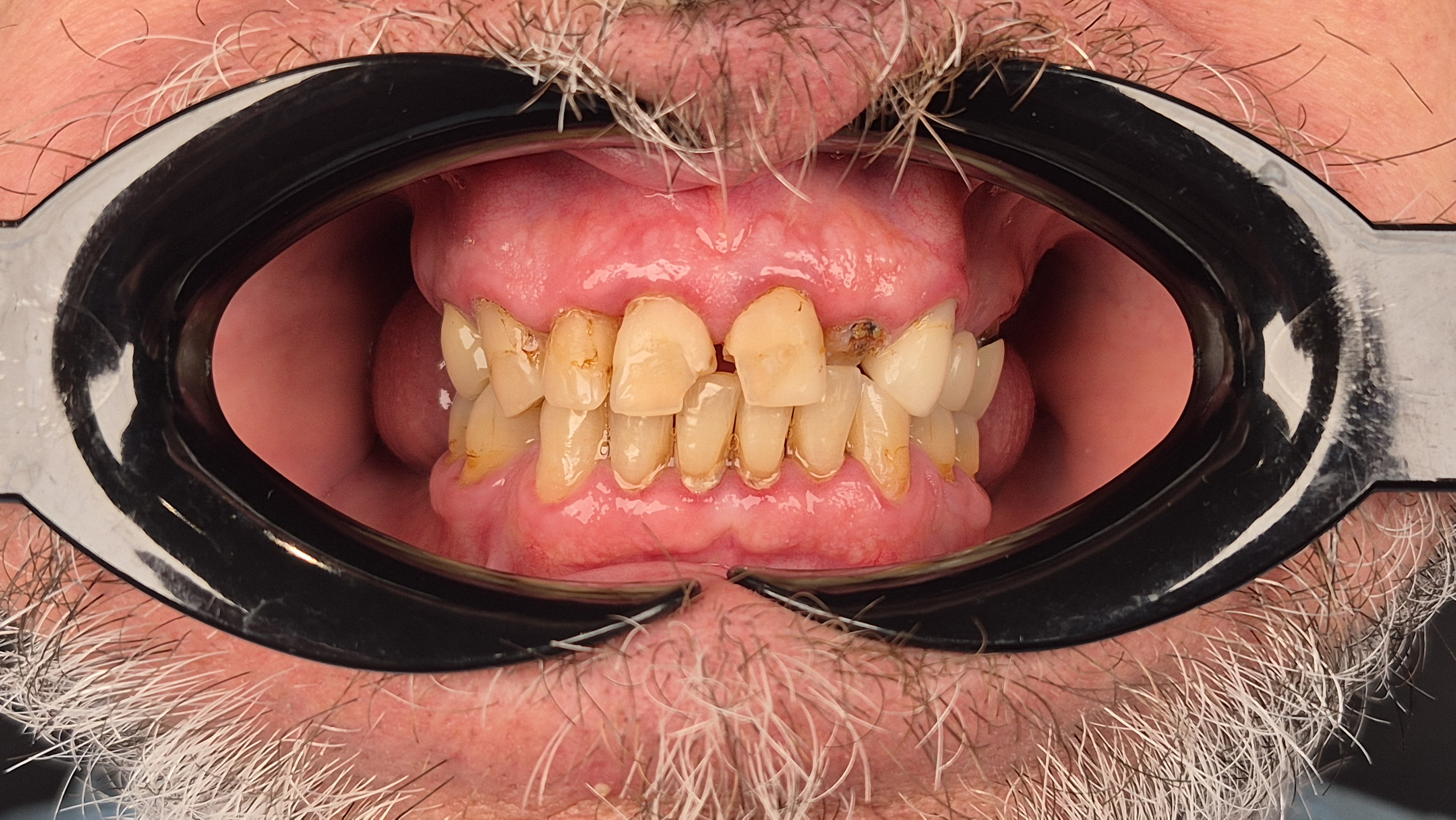 Before dental treatment case 2